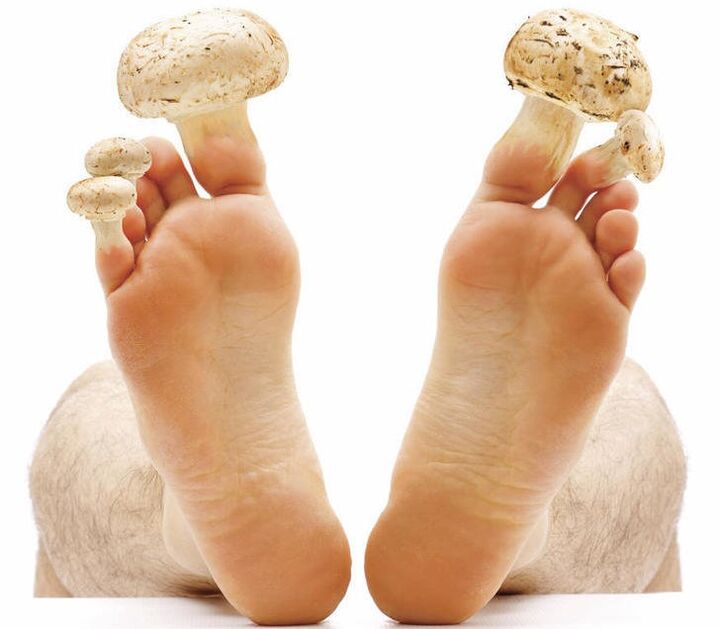Fungus of the foot and nails