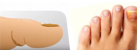 Fungus on toenails
