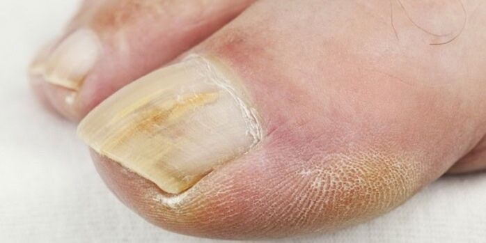 Symptoms of toenail fungus