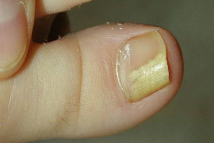 Symptoms of a fungus on the big toe Photo 1