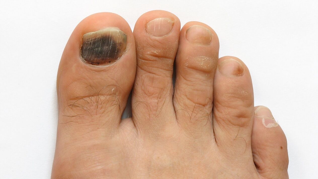 Symptoms of a fungus on the big toe Photo 2