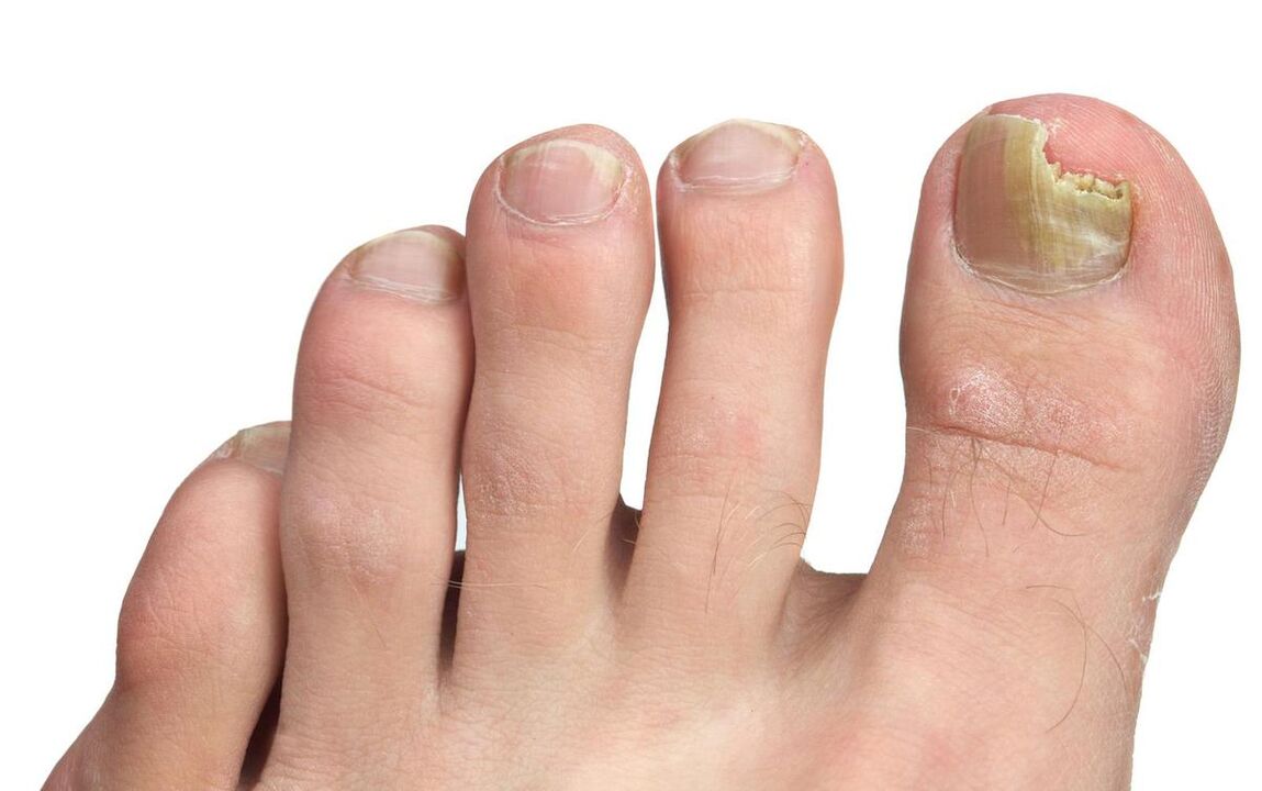 Symptoms of a fungus on the big toe Photo 3