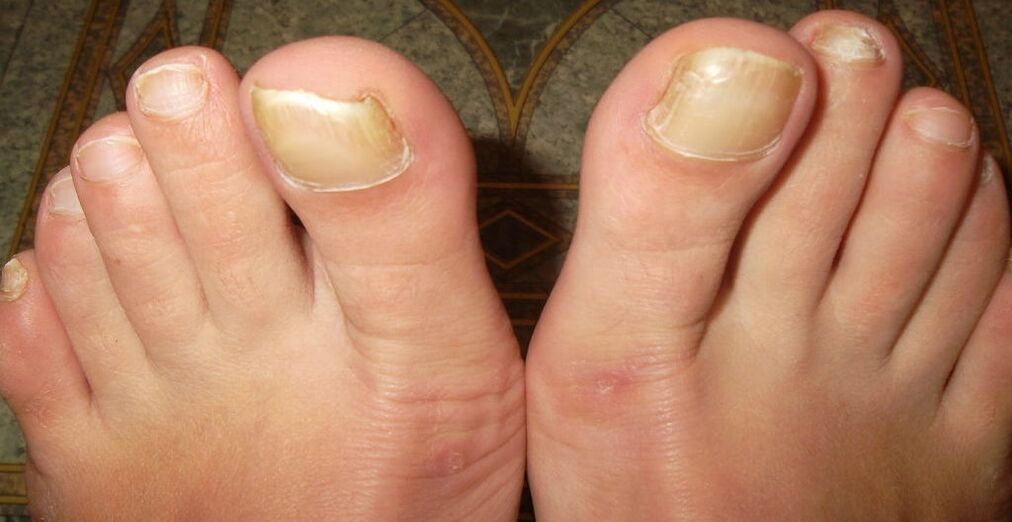Early stages of toenail fungus