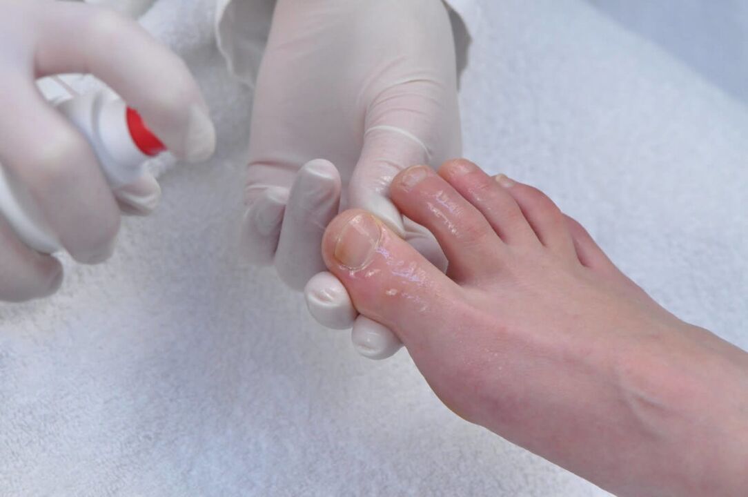 Spray for treating nail fungus