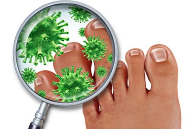 Fungal infection on the toenails