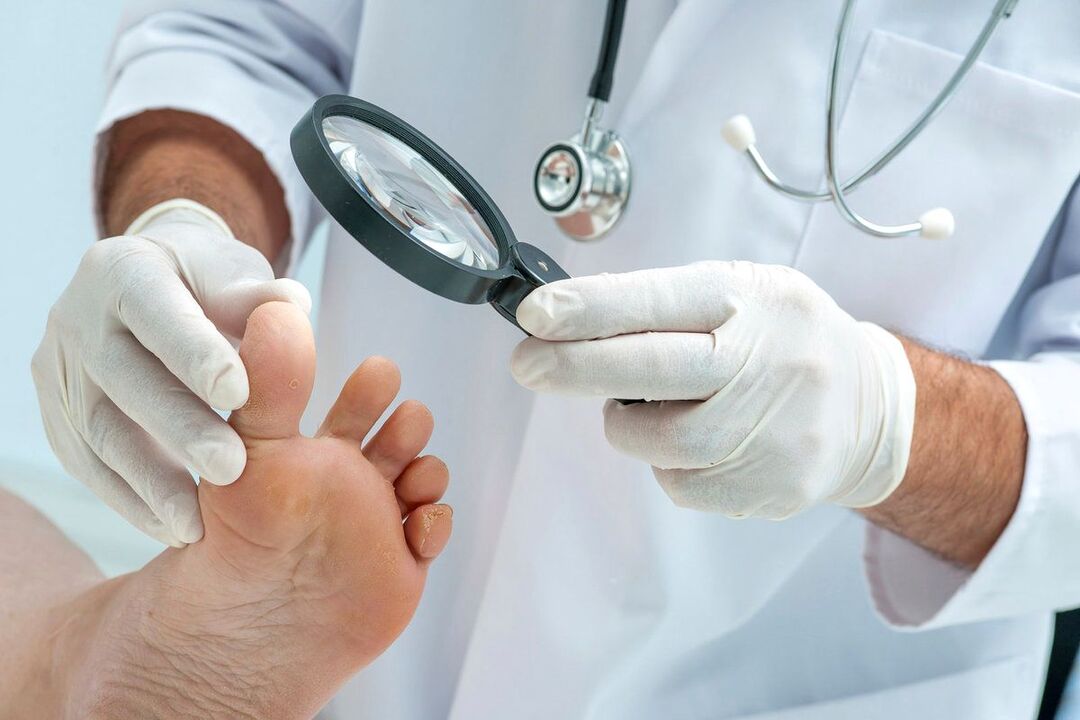 doctor examines feet with fungus