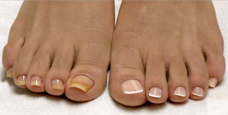 Healthy nails and toenail fungus