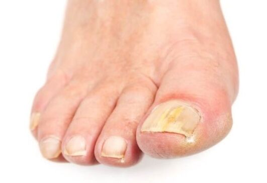 athlete's foot symptoms