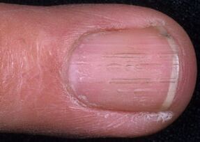 Signs of toenail fungus