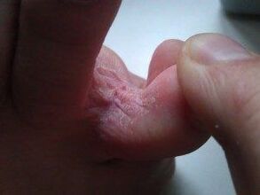 Skin lesions between the toes with a fungus