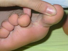 toe fungus symptoms