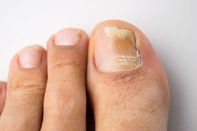 Fungus on the big toe