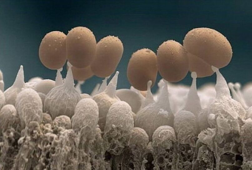 Toenail fungus under the microscope