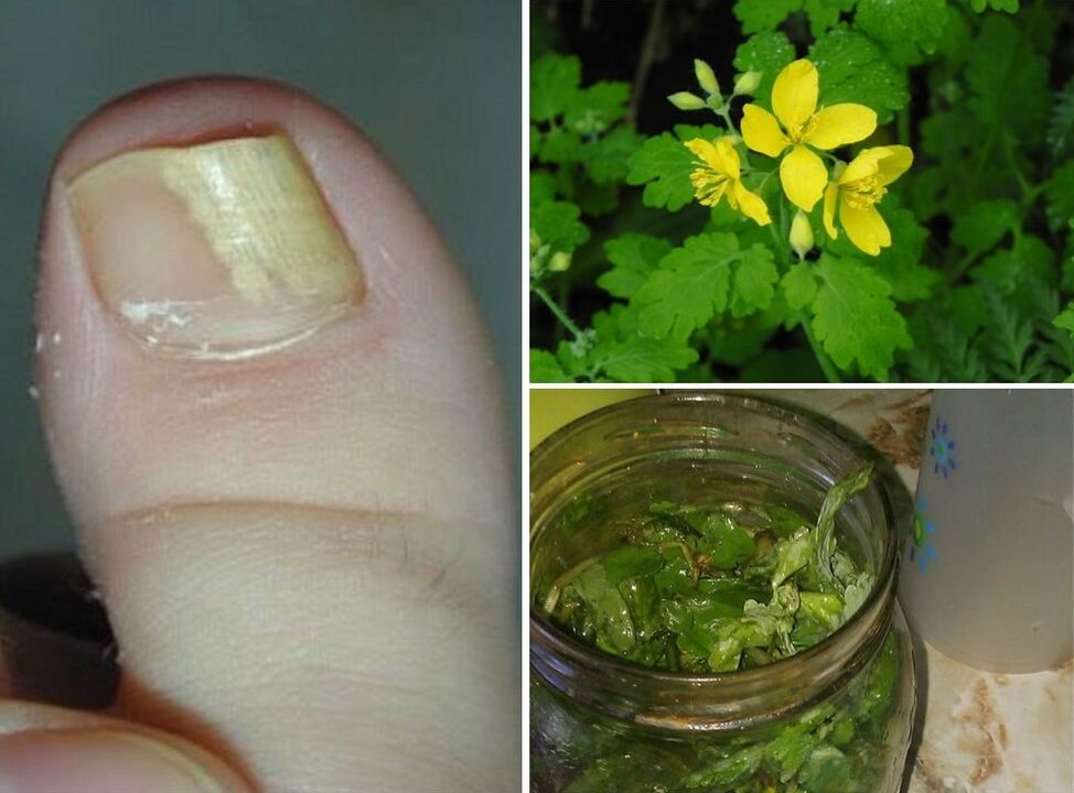 Celandine used to treat toenail fungus