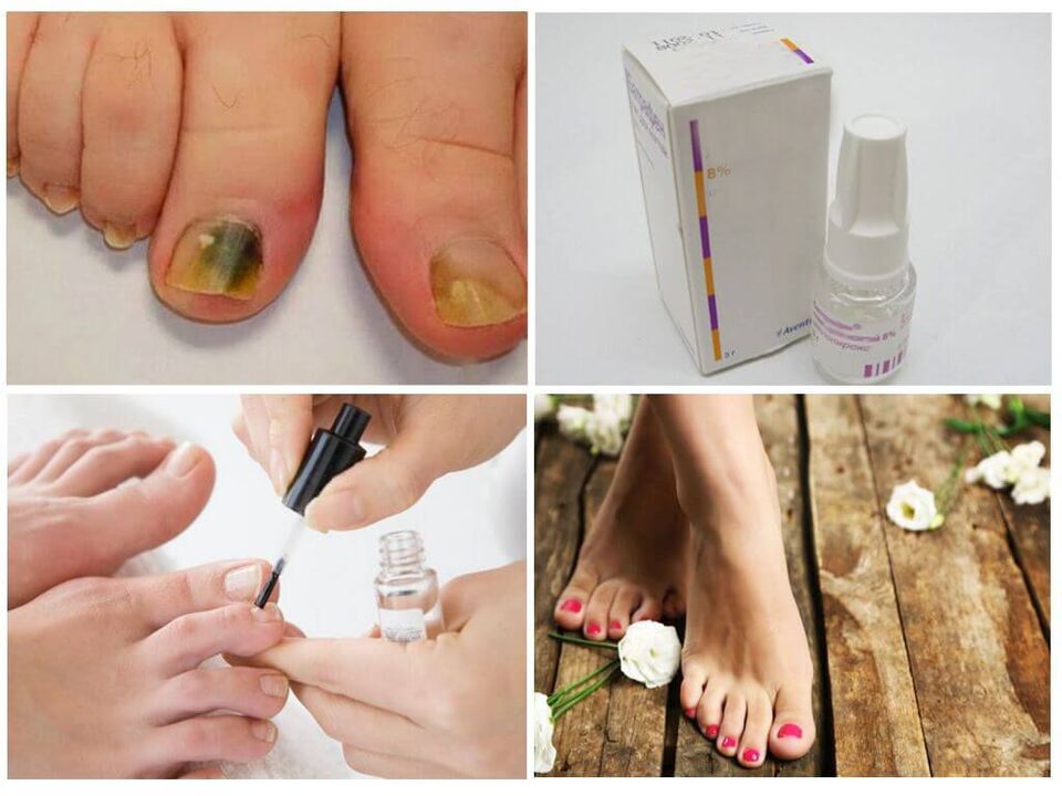 how to use nail polishes against nail fungus