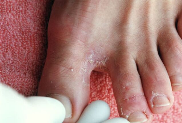 Manifestations of an intertriginous fungus between the toes