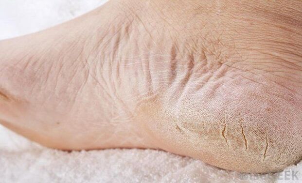 Dry feet are a sign of fungal infection
