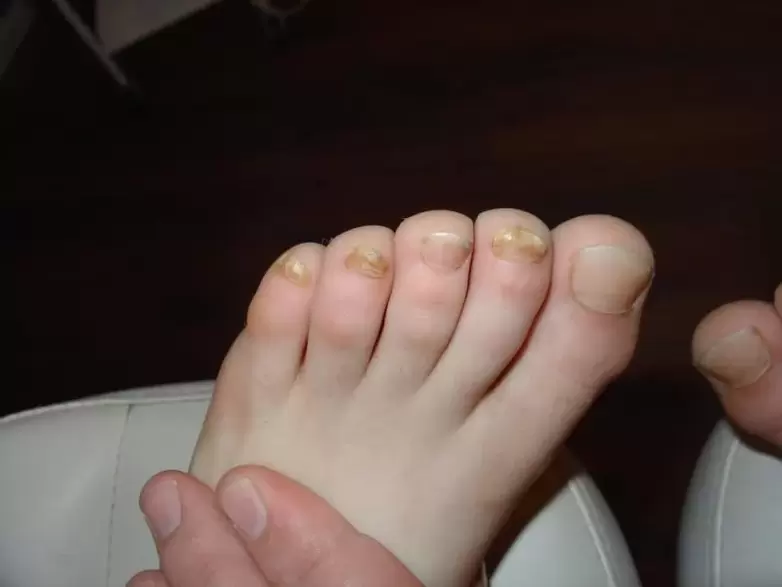 Nail fungus