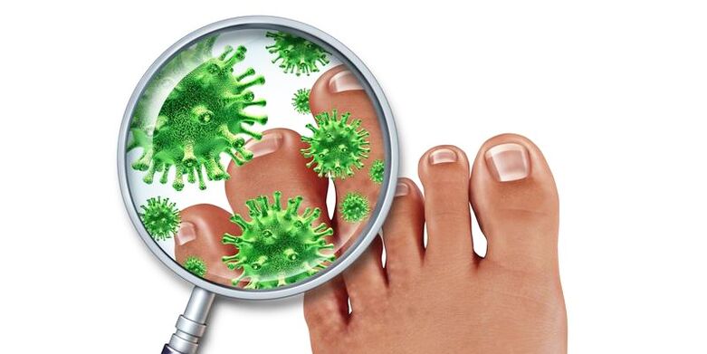 Nails infected with a mushroom
