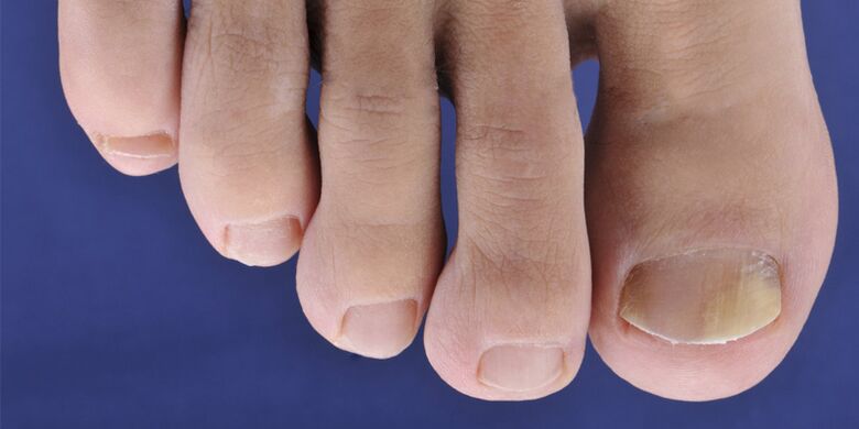 Symptoms of skin mycosis and nail plates