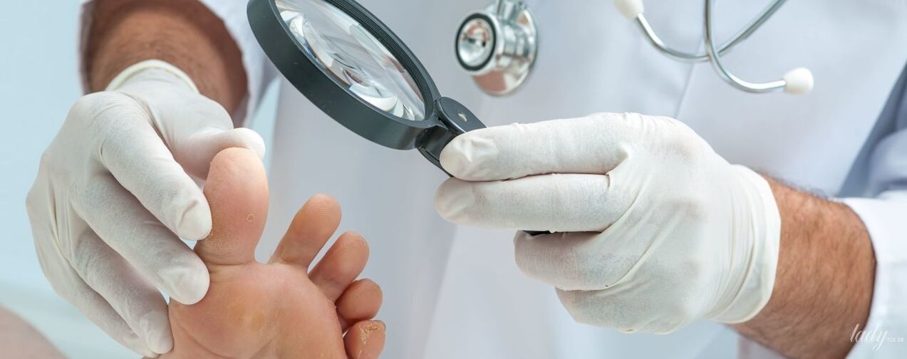 The doctor examines the mushroom on the toe