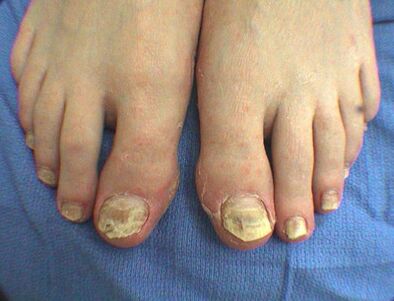 Symptoms of nail fungus