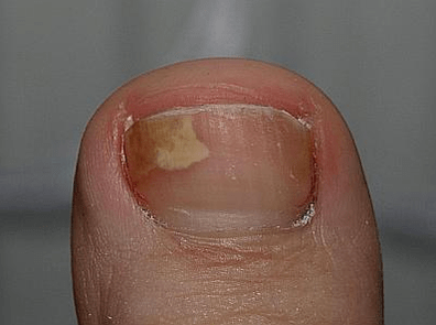 Mushroom on the left side of the nail
