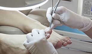 Surgical removal of the nail in the presence of a mushroom