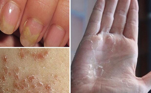 Can change mycosis to other parts of the body