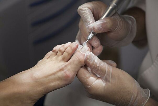 Diagnosis of the mushrooms of the legs