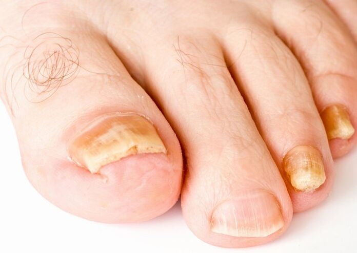 Yellowing of the nail plate due to fungal infection