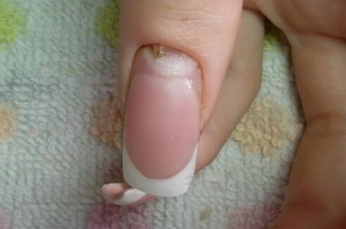 Symptoms of nail fungus