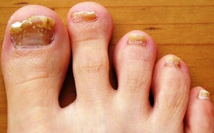 Toenails affected by fungus