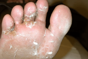 Fungus on fingers and feet