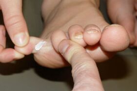 Fungus on toes