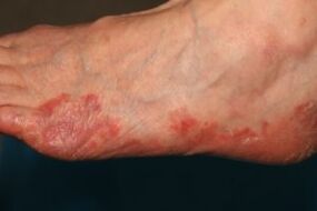Manifestations of fungus on the feet