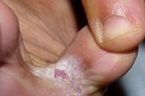Symptoms of a fungus between the toes