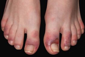 Symptoms of a fungus on the toes