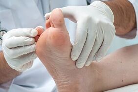The doctor examines the feet for fungal infections on the toes