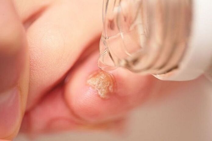 Toenail fungus treatment with vinegar