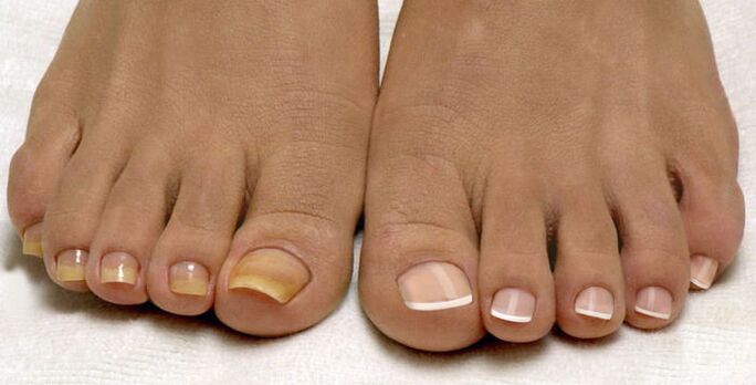 healthy toenails and nails affected by fungus