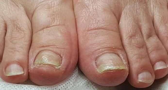 Damage to the nails with fungus on the feet