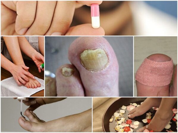 Types of toenail fungus remedies