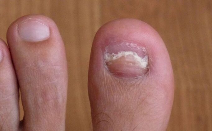 Damage to the nail on the big toe with a fungus