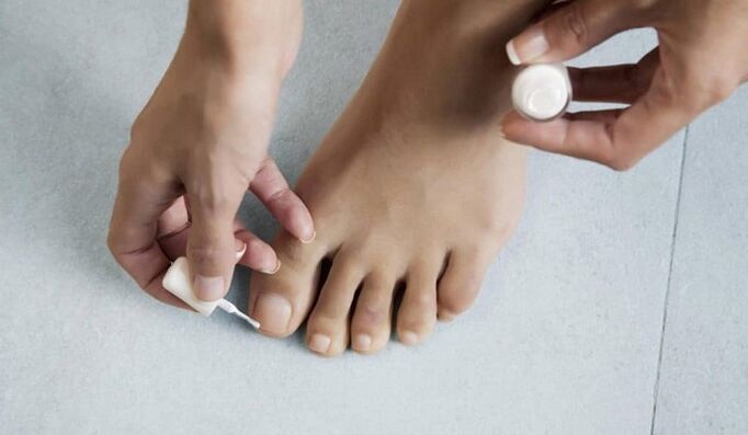 Treatment of fungus on the big toe with varnish