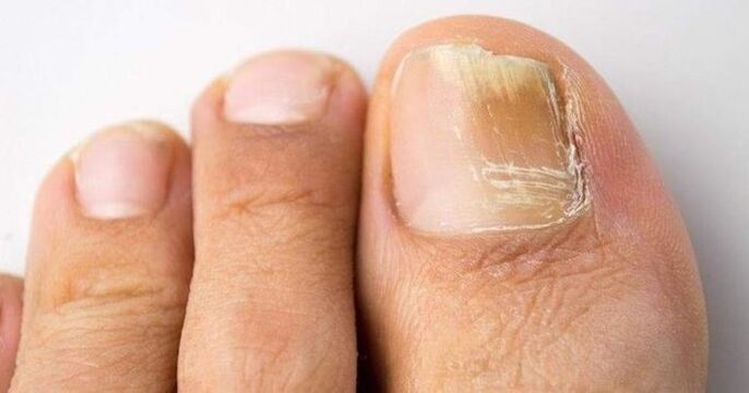 yellow toenail with fungal infection