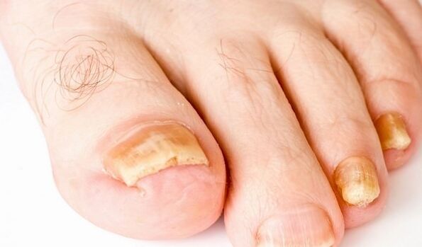 Photo of toenail fungus symptoms