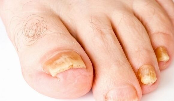 yellow toenails for fungal infections
