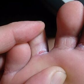 Fungal symptoms crack between the toes